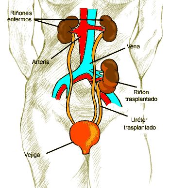 trasplante-riñón 1